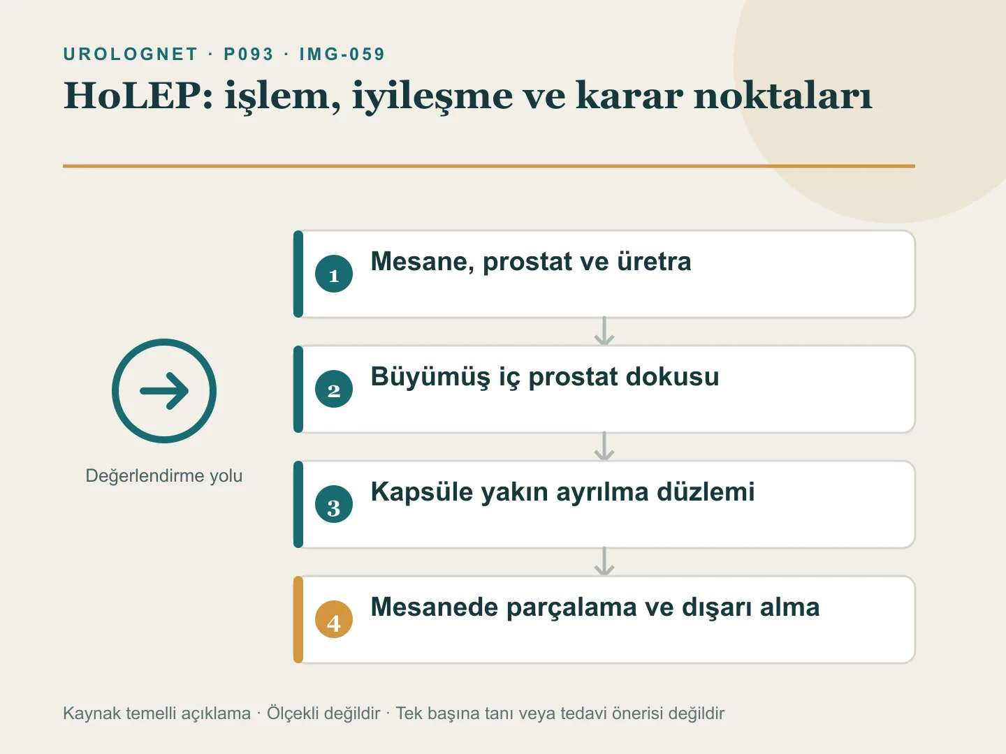 HoLEP işleminde büyümüş prostat dokusunun kapsül düzleminden ayrılıp mesanede küçük parçalara bölünerek çıkarılmasını gösteren şema.